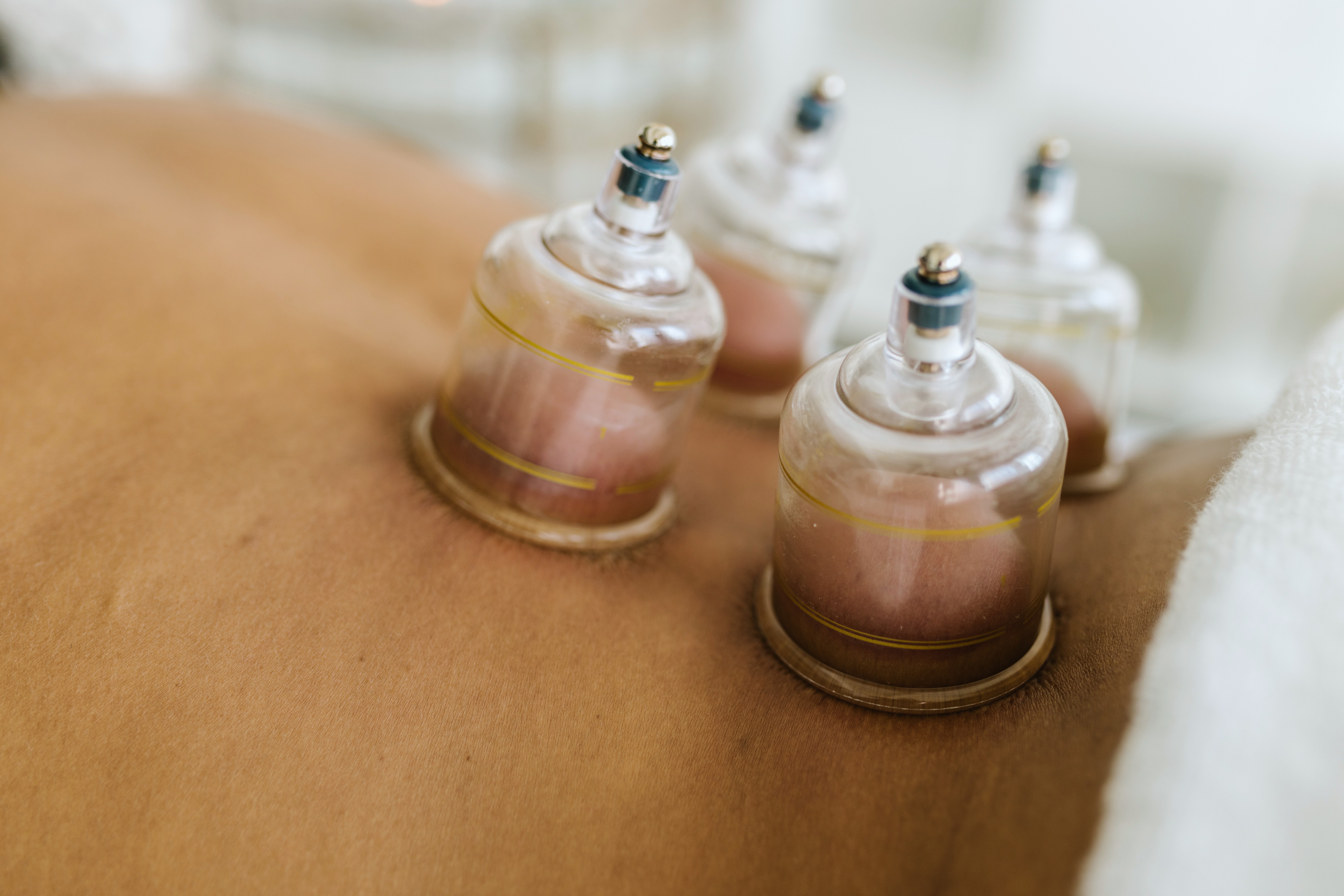 Glass suction cups applied to a patient's back during a cupping session