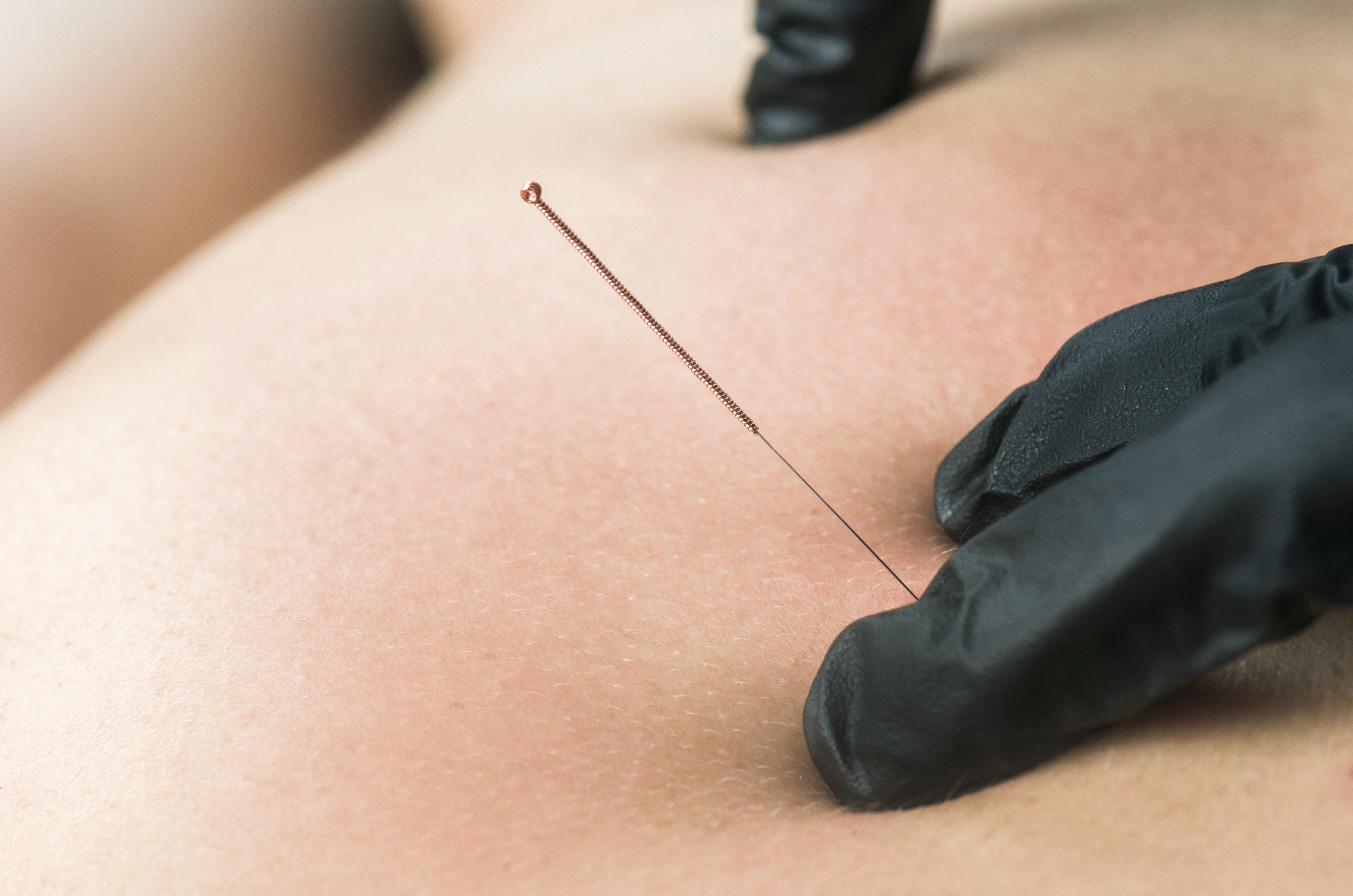 Close-up of a filiform needle being inserted during dry needling treatment